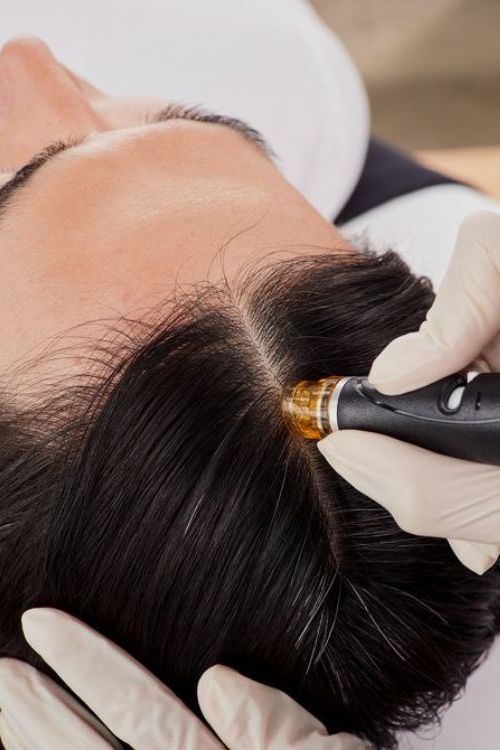 Exosome Hair Therapy