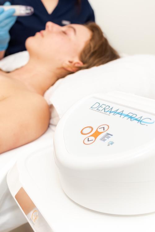 Microneedling & Collagen Induction